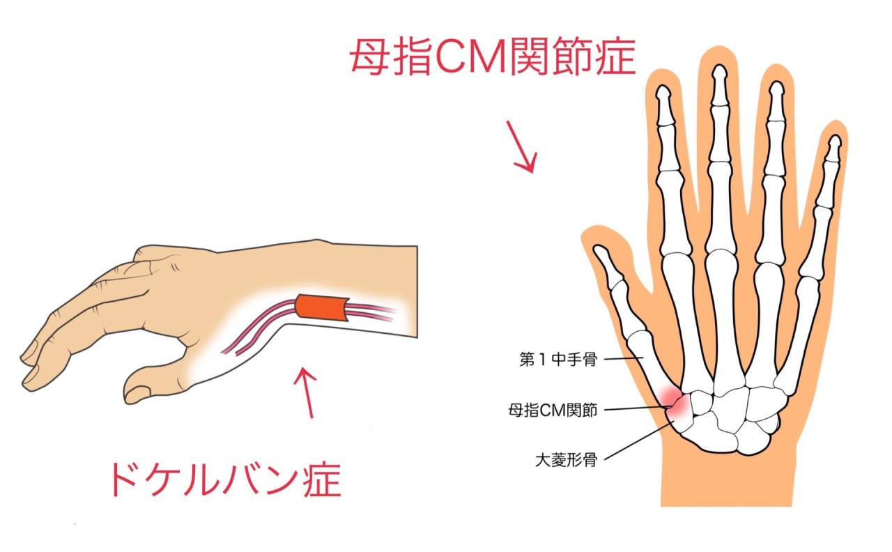 親指の付け根が痛い原因は?日常動作から見直すセルフケア | コラム | 西船橋で整体なら西船橋駅前整体院