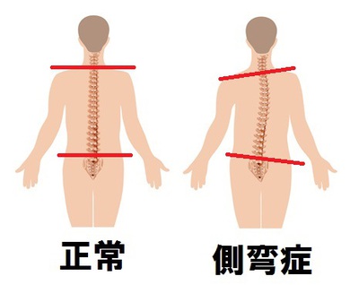 側弯症とカイロプラクティック・整体 | コラム | 西船橋で整体なら西船橋駅前整体院