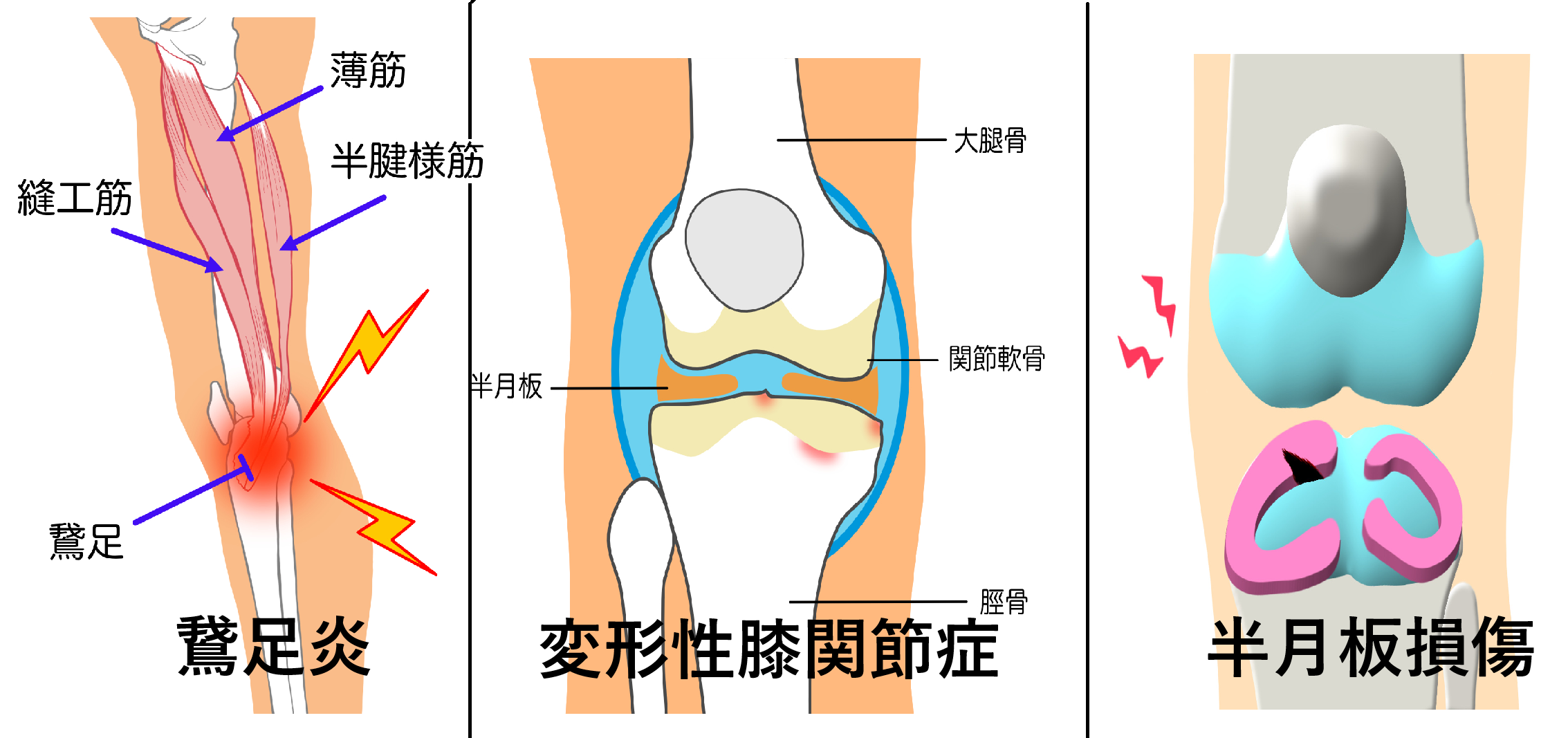 膝関節の痛みの原因を知ろう！上手に付き合うコツとは？ | コラム
