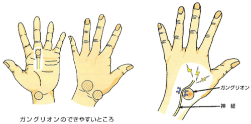 手の甲の骨の出っ張りは何？カーパルボスとガングリオンの正体