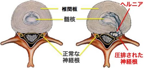 腰椎椎間板ヘルニアは治るのか？（腰痛）